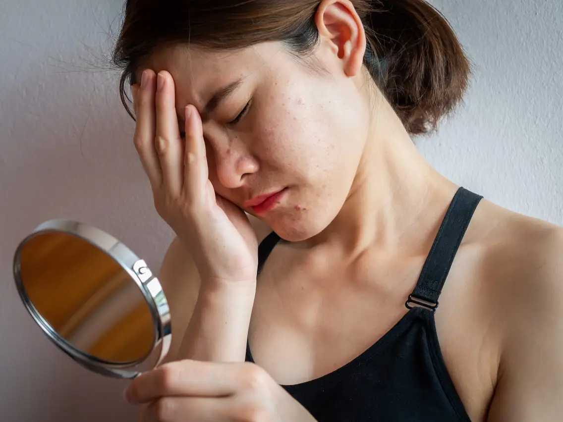80% phụ nữ được hỏi không cảm thấy tự tin với làn da của mình van-de-ve-da